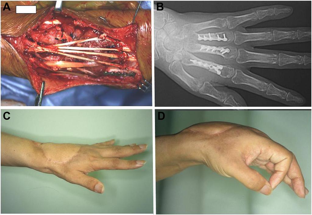 Omori et al. World Journal of Surgical Oncology (2015) 13:179 Page 3 of 6 Figure 2 Intraoperative view and postoperative hand function.