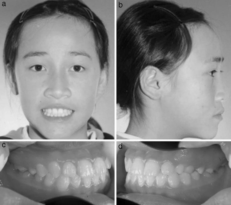 IMPACTED MAXILLARY CANINE AND FIRST PREMOLAR 503 FIGURE 1. (A D) Pretreatment facial and intraoral facial photographs. and medical history was unremarkable with only the usual childhood maladies.