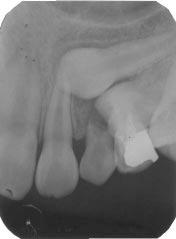 504 PENG, SU, LEE FIGURE 3. Pretreatment periapical radiograph of the left upper canine-premolar region. Note that the root axes of both impacted teeth were quite parallel to the occlusal plane.