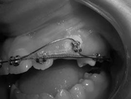 IMPACTED MAXILLARY CANINE AND FIRST PREMOLAR 505 FIGURE 5. A left buccal view during treatment shows a 0.