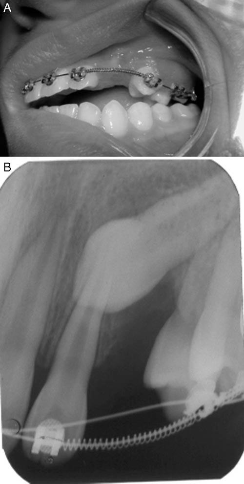 506 PENG, SU, LEE FIGURE 8. Periapical radiograph shows the roots of first premolar and canine well aligned. FIGURE 7. Buccal view (A) and periapical radiograph (B) after first premolar correction.