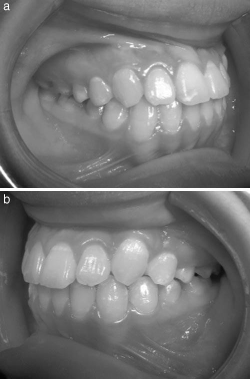 IMPACTED MAXILLARY CANINE AND FIRST PREMOLAR FIGURE 9. (A and B) Posttreatment intraoral photographs. FIGURE 10. Posttreatment panoramic radiograph.