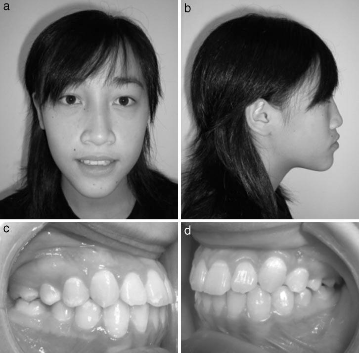 508 PENG, SU, LEE FIGURE 11. (A D) The facial and intraoral photographs at the 17-month posttreatment follow-up shows that the midline, overjet, and overbite are still in good position.