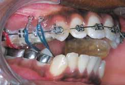3 Although corticotomy is an old technique dating back to the early 1900s, it was not properly introduced until Wilcko developed the patented technique named Accelerated Osteogenic Orthodontics