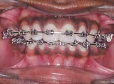 5-9 This technique was originally designed to enhance tooth movement, subsequently reducing treatment time via inducing cortical bone injury through linear cutting (corticotomy) and then performing