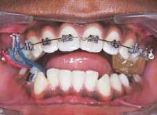022" MBT preadjusted appliance was bonded in the upper arch with double tubes banded on the upper molar and single tube banded on the lower left molar and bands were cemented, which were welded with