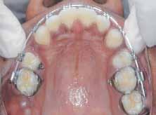 Post-treatment intraoral view, (D and E) post-treatment occlusal view 16