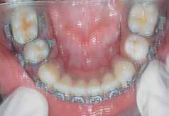 preventing the mesial movement of the third molar completely, thereby