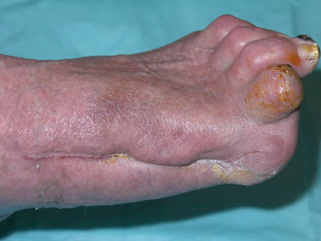 HAMMER-TOE DEFORMITY Claw-toe deformity with