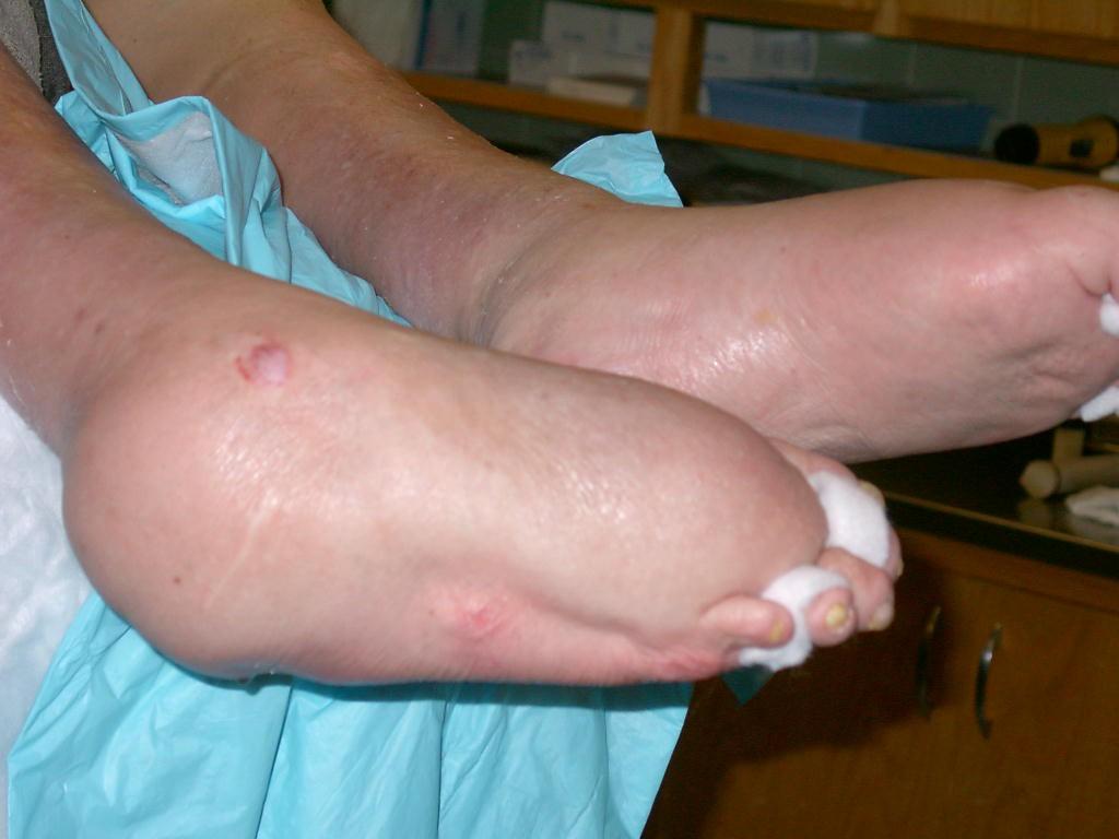 Early treatment of the diabetic foot improves function and