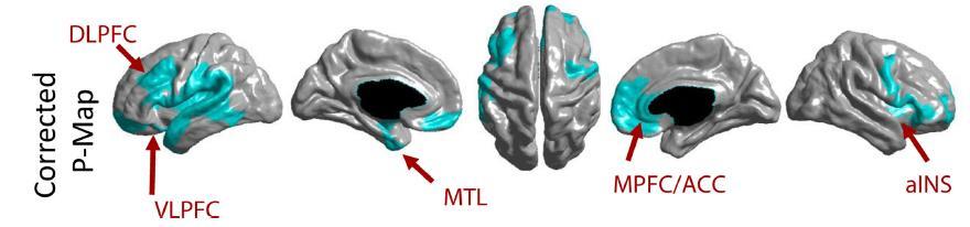 Chronic Pain State Cortical thinning in CLBP