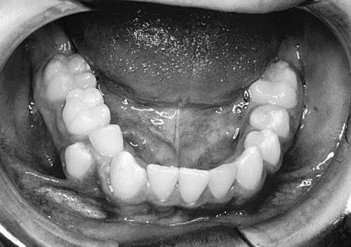 Photograph of a 12-year-old girl showing mandibular canine and lateral incisor aligned in their transposed position. FIGURE 2.