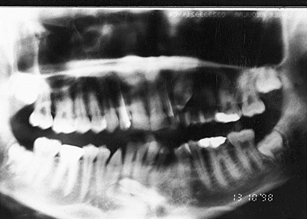Occlusal radiograph of a 12-year-old girl with an odontoma causing mesial displacement of the impacted mandibular canine migrating across the midline. FIGURE 7.