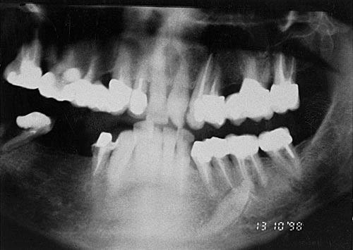 This intrabony migration apparently commences at the early mixed dentition and may take place over a period of several years.