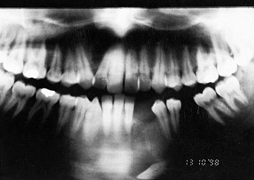 INTRABONY MIGRATION OF IMPACTED TEETH 741 FIGURE 8. The displaced mandibular canine is horizontally impacted close to the inferior border of the mandible, as detected on a panoramic radiograph.