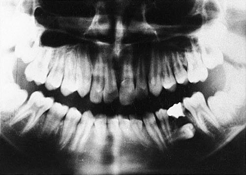 Panoramic radiograph showing mandibular left second premolar horizontally impacted under the roots of the retained deciduous second molar. 0.