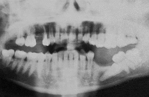 24 Distal displacement and intrabony migration of the mandibular second premolar are idiopathic and have been reported to occur only unilaterally.