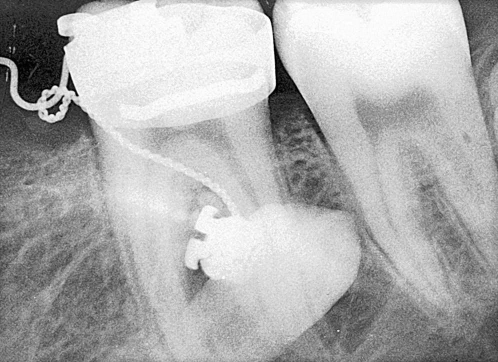 The tooth bud of the mandibular second premolar may develop with a variable degree of distal inclination under the distal root of the deciduous second molar (Figure 9).