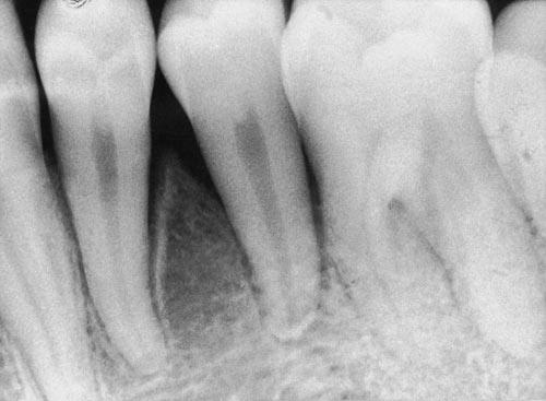 742 SHAPIRA, KUFTINEC REFERENCES FIGURE 12. Periapical radiograph at the end of orthodontic treatment showing the impacted mandibular second premolar aligned in the arch.