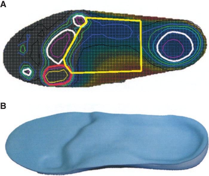 Insoles for enhanced plantar pressure reduction Figure 1 A: Screen shot of the insole design program used for the shape-plus-pressure based insole Z.