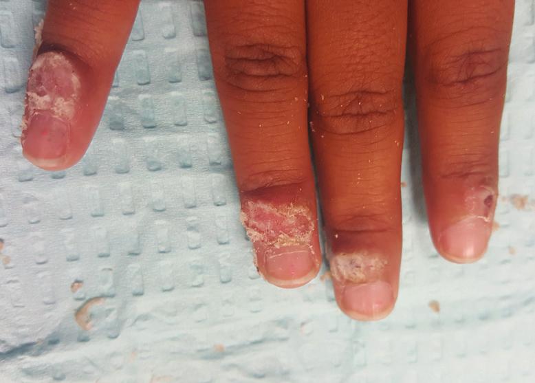 An eight-year-old female with extensive warts on the fingers had failed multiple cryotherapy treatments with PCP.