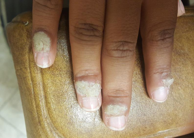 Since unaffected skin is far more sensitive, irritation results, and the patient is forced to stop treatment before the wart has resolved completely.