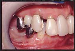 She had been using only her anterior teeth to bite and experienced nerve paralysis even two years after the accident.
