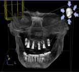 Fig. 10: Bone augmentation with Bio-Oss and Bio-Gide to