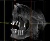 CT(3D)data were taken with the depth gauges during the surgery.