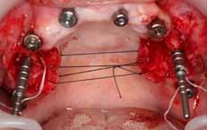 The surgical stent supported by the four anterior implants was