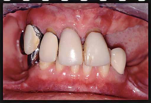 ConclusionS This case represented a challenging treatment approach including ridge preservation, bone augmentation and orthodontic treatment.