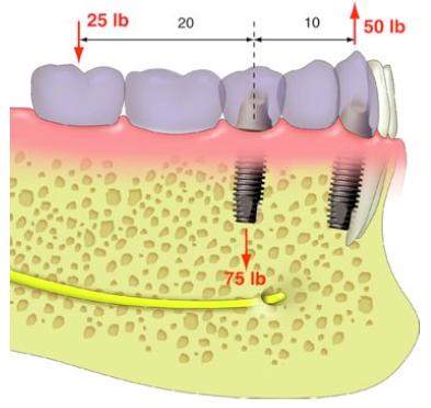 Cantilevers Force on cantilever : compressive Force on furthest abutment: tensile and shear Force on closest abutment (fulcrum): compressive Misch CE.