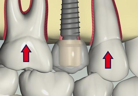 Teeth intrude 25-100 microns Implants intrude 3-5 microns Kim Y, Oh T, Misch C, Wang H.