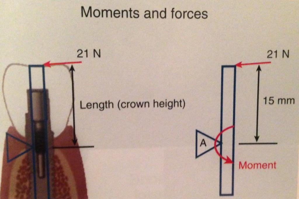 Crown Height Crown height directly increases effect of angled force 100 N load at a 12 angleà 21 N of lateral/shear force 15mm Crown x 21N force = 315 N-mm moment force