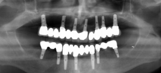 Opposing Arch Complete implant fixed prosthesis do not have propioception Patients bite with 4x