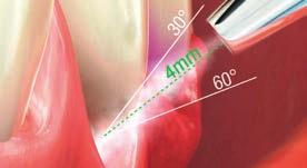 SUBGINGIVAL AIR POLISHING SUPPORTIVE MAINTENANCE IN GINGIVITIS / PERIODONTITIS THERAPY APPLICATION < 4 mm DISTANCE 4 mm Hold the nozzle near the tooth surface at a maximum distance of 4 mm.