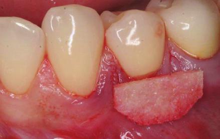 firmness when hydrated to facilitate easy placement in graft