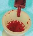 Blood is most easily obtained from the surgical site or venipuncture of the antecubital fossa. 3.