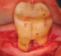 Typical QuANTITy Buccal Defect 50 500 0.25 0.