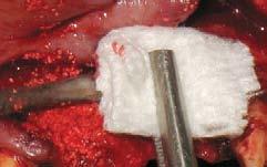 SMALL BONE DEFECT SynthoGraft is ready
