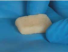 - Osteoconductive - DBM provides ideal scaffold that directs and supports bone formation -Easy storage and use - stores at room temperature, ready for immediate use, no