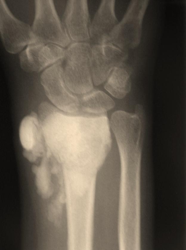 One patient with a giant cell tumor of the distal radius, in addition to having a recurrence, sustained a closed fracture after the index procedure which healed with cast immobilization.