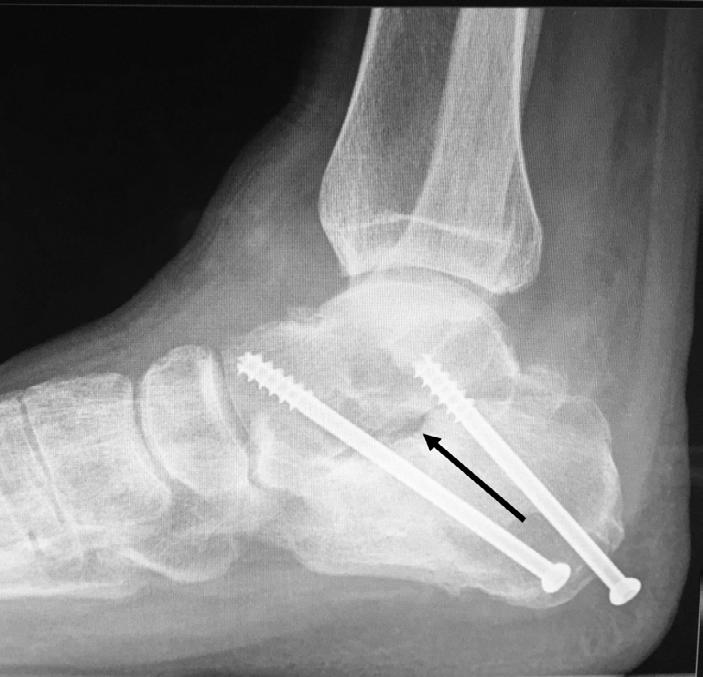 right lateral ankle x-ray shows excellent position and