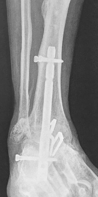 Figure 2: Pre-operative anteroposterior right ankle
