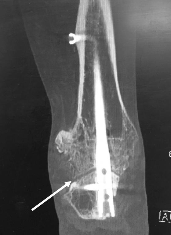shows nonunion at the subtalar joint (arrow) and