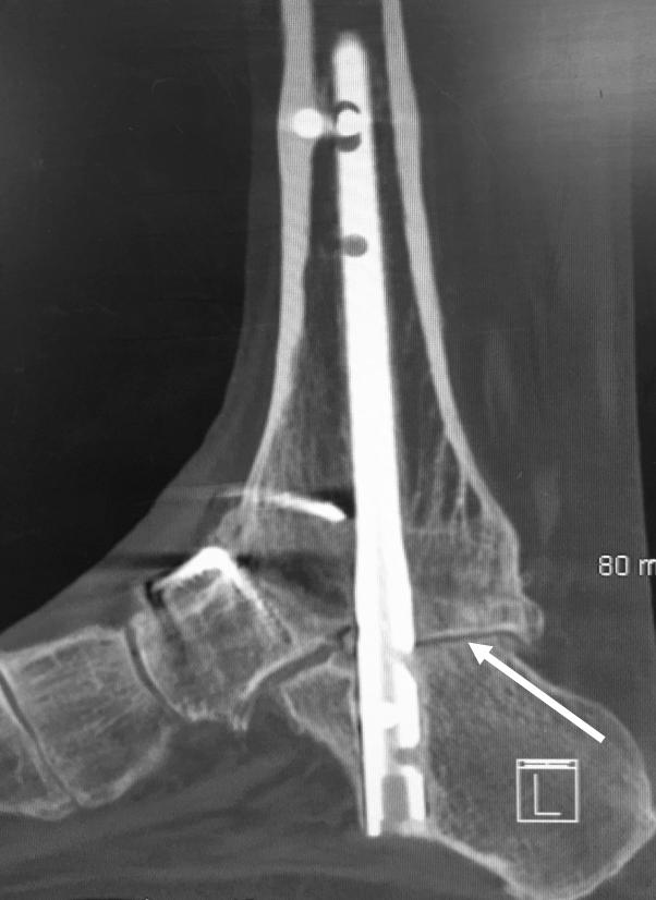 sagittal ankle CT scan shows complete nonunion of