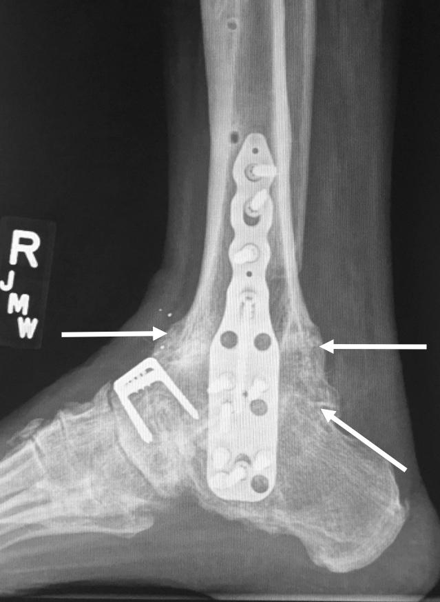 Subtalar Nonunions 8-month post-operative Figure 9: 8-month post-operative right lateral