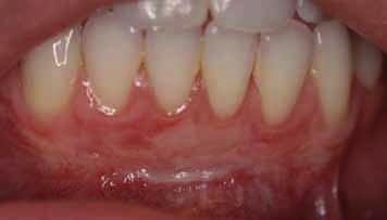 Figure 29: Incision made at mucogingival