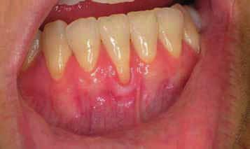 Figure 1: Localized gingival recession on
