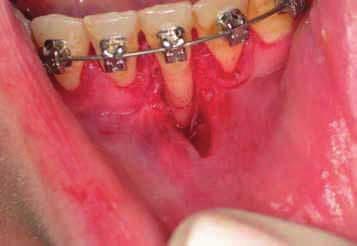 loss in association with orthodontic treatment.